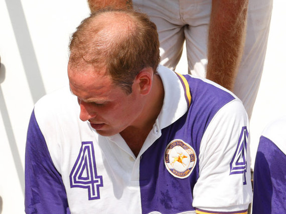 celebrity-hair-loss-prince-william