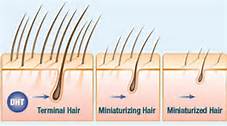 the-best-treatment-for-hair-loss-follicle-miniturization