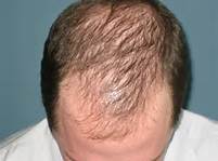 the-best-treatment -for-hair-loss-receding-hair