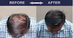 the-best-treatment-for-hair-loss-thickening-2